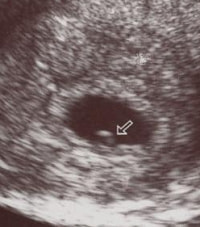 妊娠5週の赤ちゃん