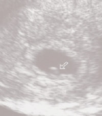 妊娠5週の赤ちゃん