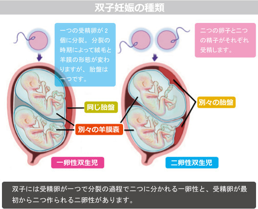 双子妊娠の種類(胎児)図解