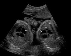 双子妊娠超音波(エコー)