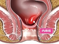 内痔核図解